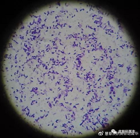 是湿疹或癣医生一眼就能辨出来吗,是不是体癣怎么检查