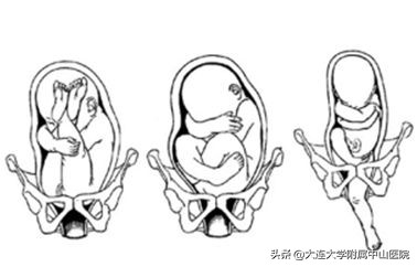 【科室推介】外倒转术：胎位不正也能顺产