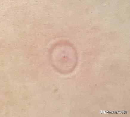 糖尿病注射胰岛素的器械在哪里买,糖尿病胰岛素无针注射器价格表