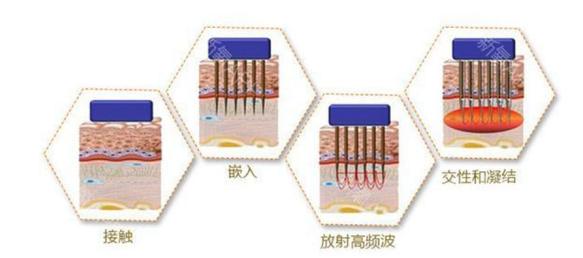 皮肤有斑点暗黄做什么医美项目,便宜又好用的医美项目有哪些