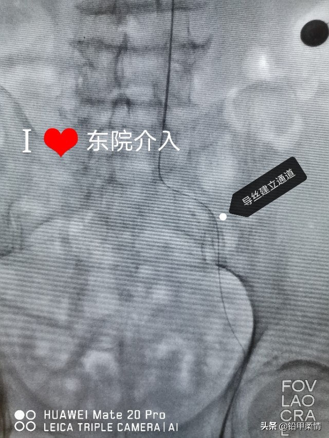 治疗髂总动脉起始端闭塞的专家,年轻人髂动脉闭塞怎么治疗