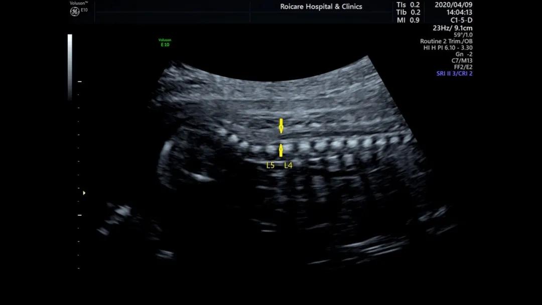 胎儿脊髓圆锥位置低是什么情况,胎儿脊髓圆锥位置偏低做核磁共振