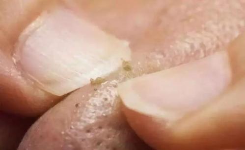 毛孔粗大医院刷酸多长时间见效,大油皮毛孔粗大怎么改善都不见效