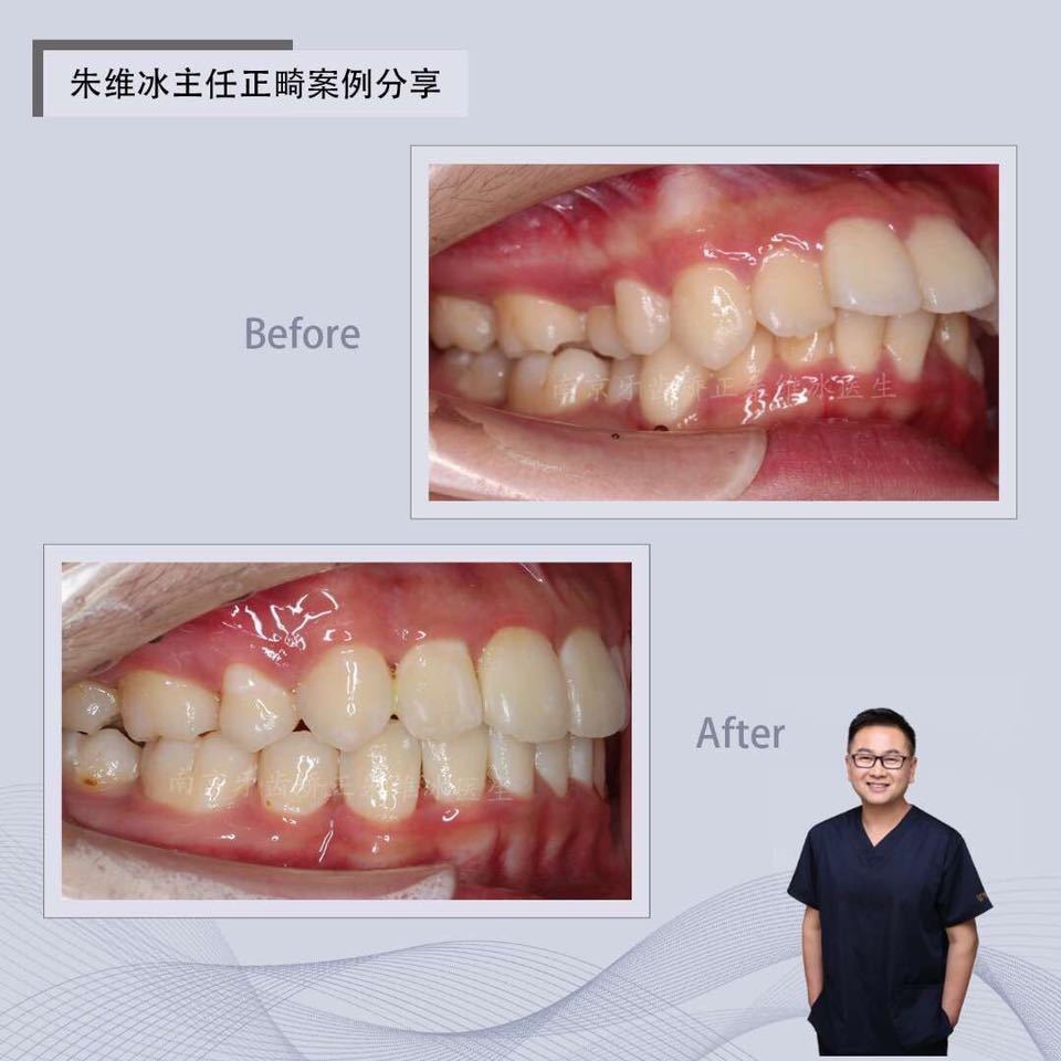 南京正畸朱维冰怎么样,南京牙齿正畸矫正技术