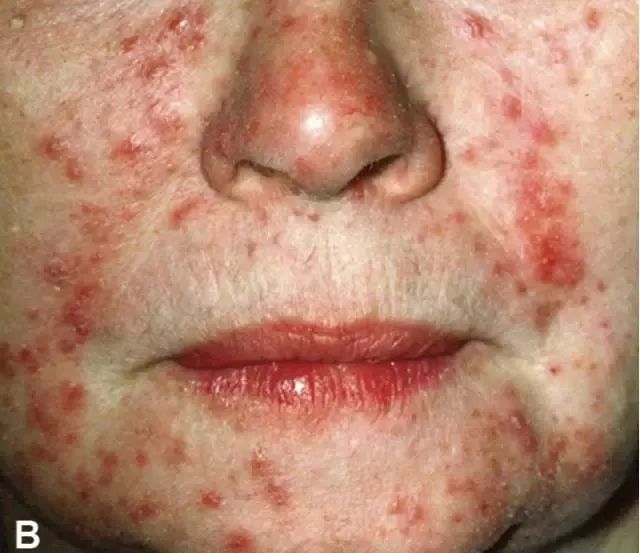 痘痘反反复复教你一招祛痘不再难,为了祛痘曾经你试过哪些方法