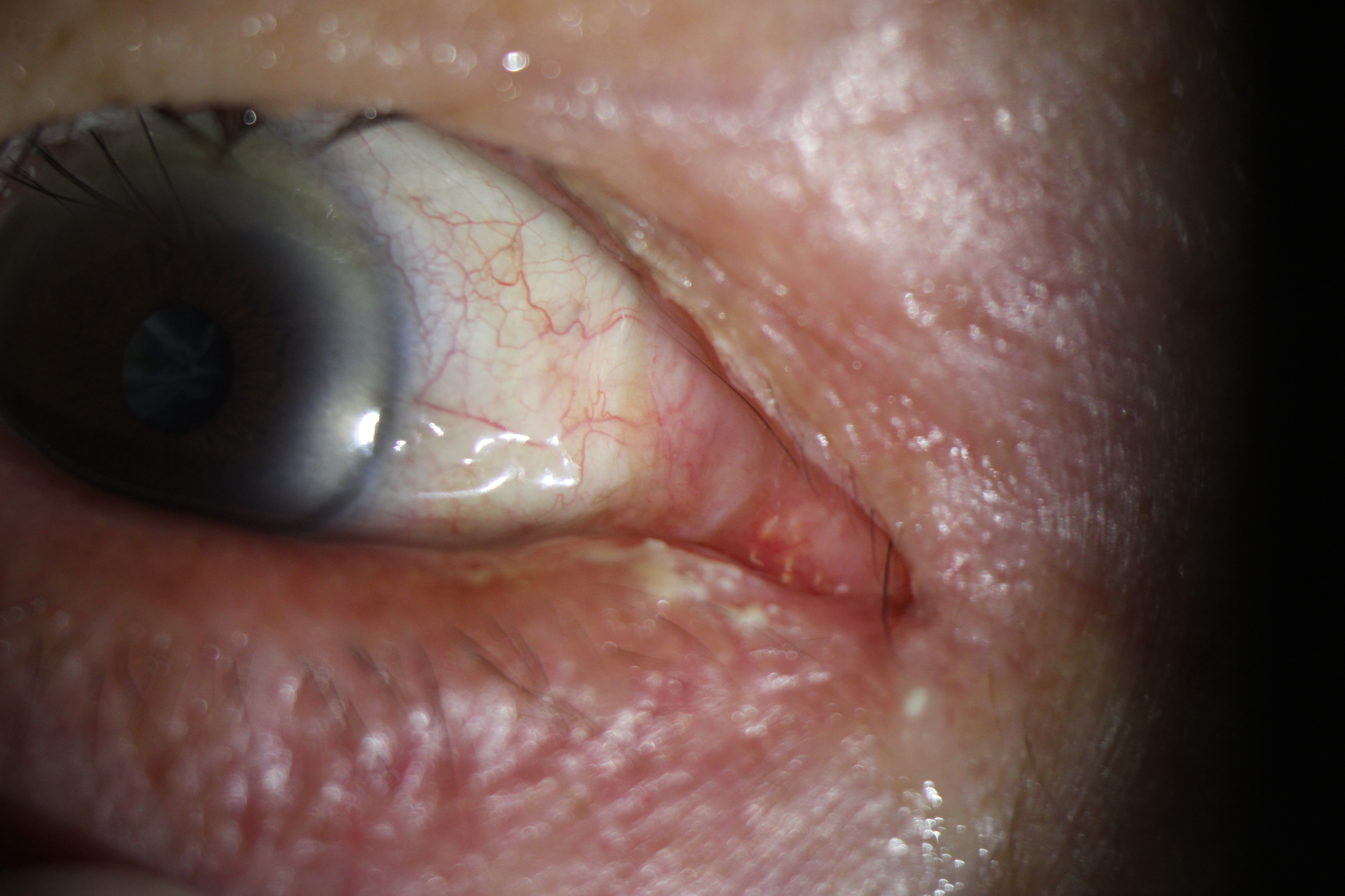 眼角碰肿了总是流眼泪怎么办,眼睛流眼泪眼角有脓