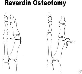 拇外翻大脚趾疼如何在家就能治,大脚拇指痛要警惕