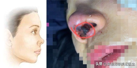 塌鼻子怎么能变成尖鼻子,鼻子太窄太小是不是很难增高鼻梁