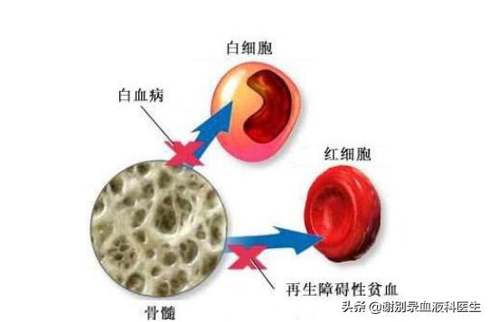 再生障碍性贫血能不能穴位治疗,再生障碍性贫血可以食疗吗