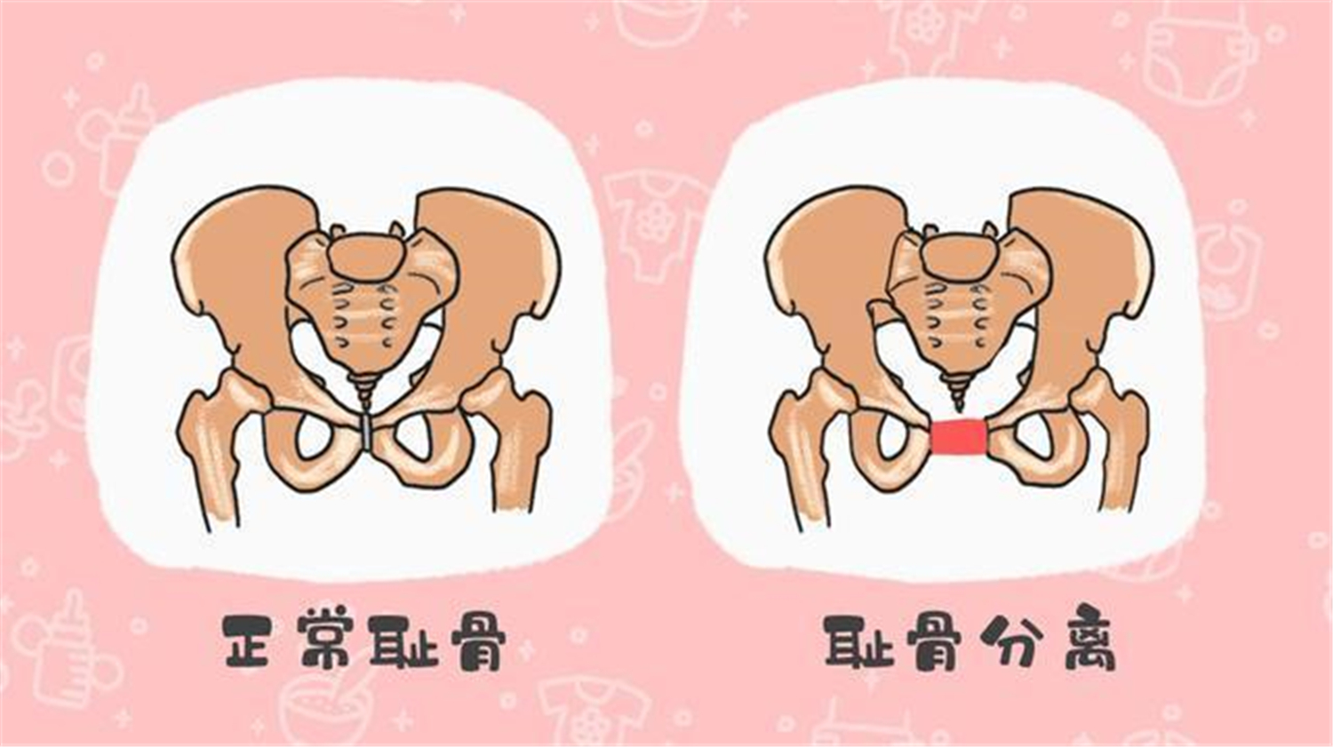 孕期“耻骨”痛到厌世?五类孕妇更易中招,缓解疼痛有妙招