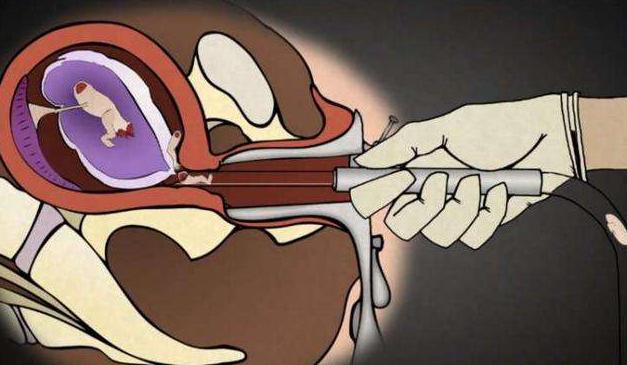 孕婴知识大全视频,不同阶段婴儿堕胎全过程