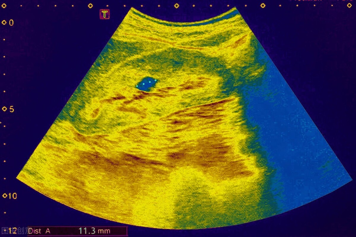 体检时发现肾囊肿怎么治疗呢,发现肾囊肿要怎么治疗好