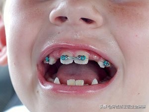 换牙牙齿从里面长出来并且歪了,换牙被挤歪的牙齿会自己长回去吗