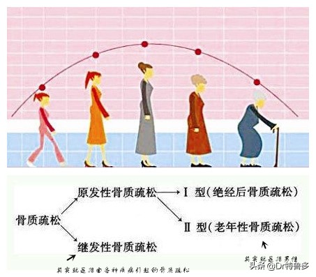 哺乳期女性补钙但是仍然骨质疏松,哺乳期妇女重度骨质疏松