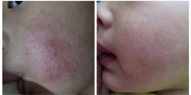 2岁宝宝脸发黄还有皮肤不均匀,宝宝快两岁了宝妈脸上有斑
