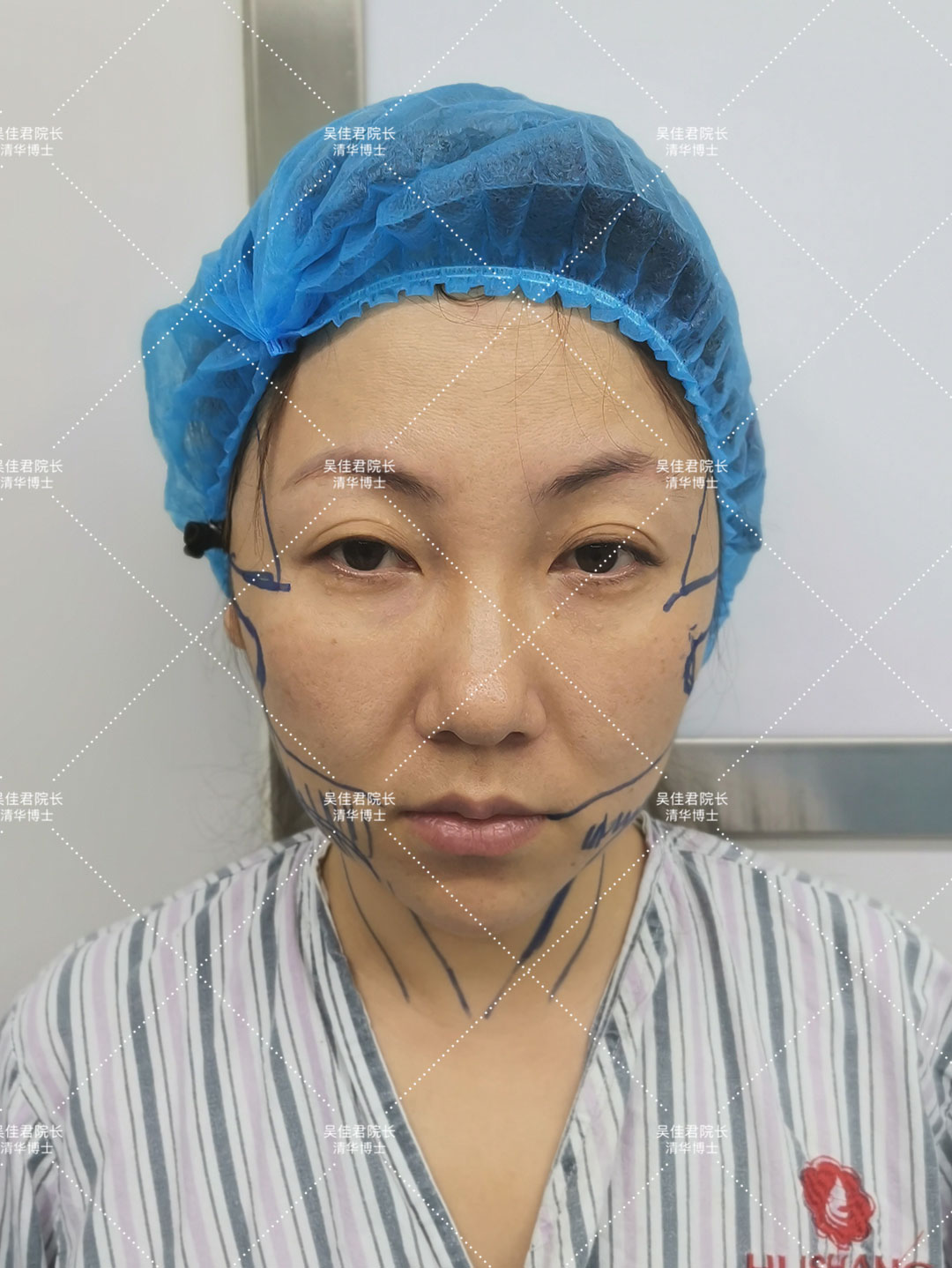 做一个拉皮手术人可以年轻多少岁,做拉皮的真实感受