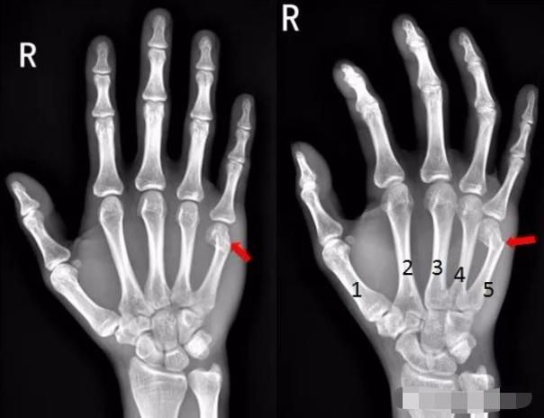 怎样发现骨折的可能性,一招看出手指骨折