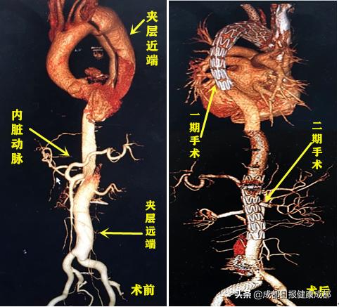 胸主动脉夹层保守治疗,年轻男子突发主动脉夹层命悬一线