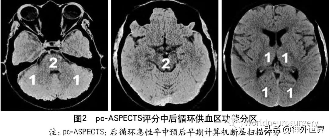 急性缺血性卒中诊治指南2023,缺血性卒中介入指南