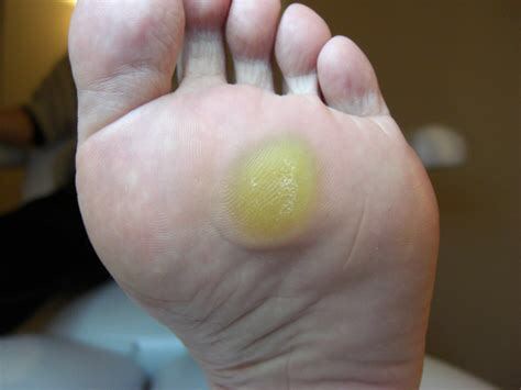 脚上长鸡眼是皮肤病吗,脚上起的是鸡眼还是疣