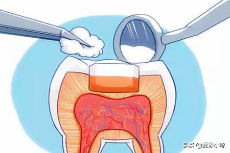 牙齿缺了一小块疼痛怎么办,牙齿缺了一块很疼怎么补救