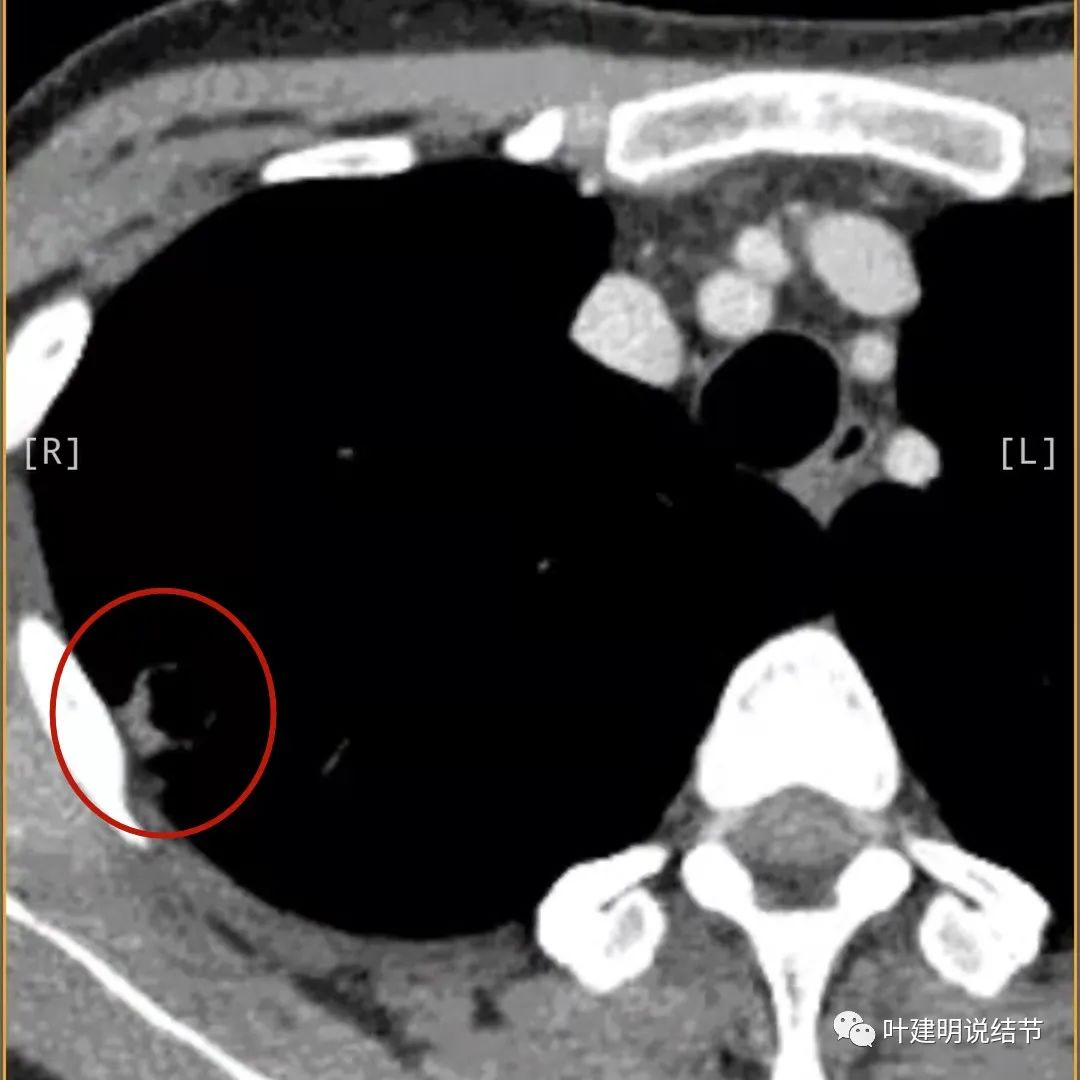 临床诊断孤立性肺结节,空洞型结节一般是什么性质