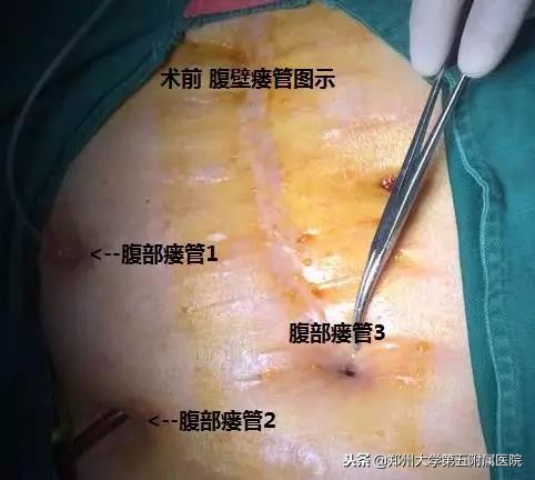 十来年肠绞痛的表现和处理方法,十年腹痛