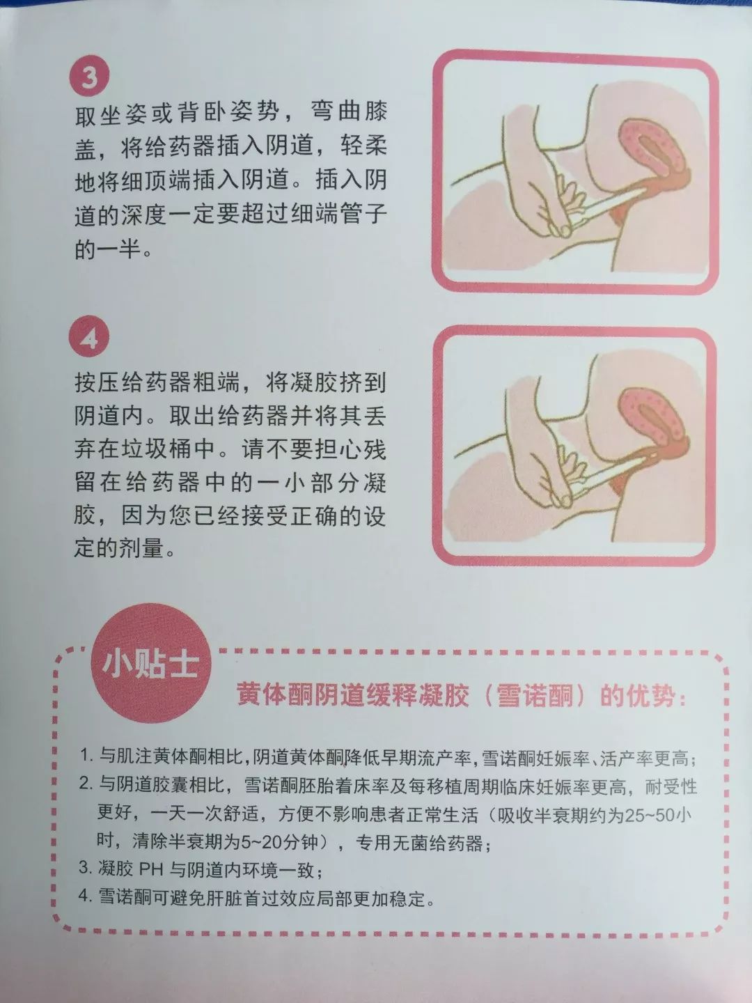 雪诺酮黄体酮缓释凝胶使用视频,用雪诺酮要注意什么