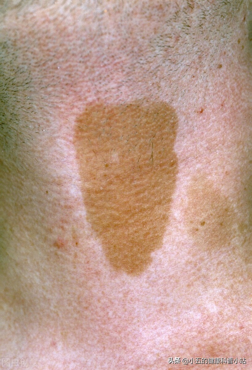 什么叫做脂肪瘤该怎么医治,脂肪瘤有什么危害脂肪瘤最怕什么