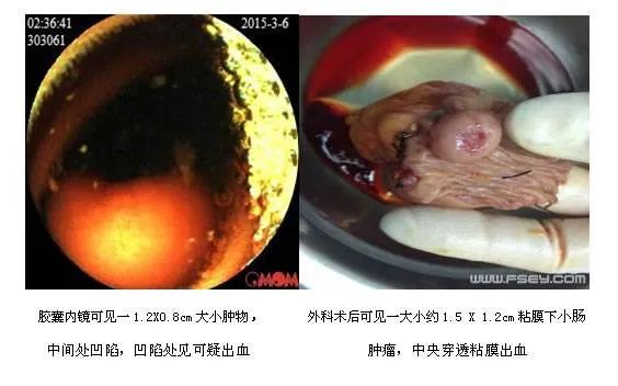 消化道胶囊内镜,消化道里的摄像头