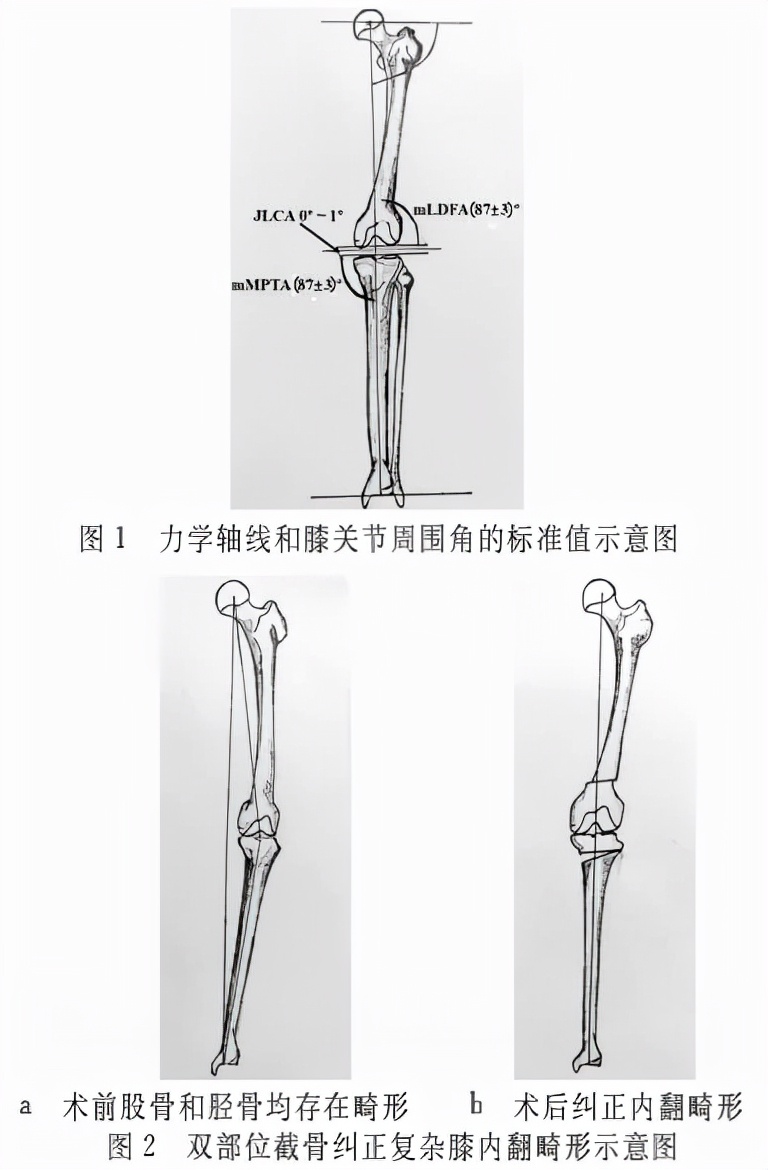股骨和胫骨双部位截骨拯救复杂膝关节内翻畸形