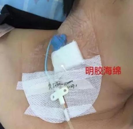 picc穿刺点有少量出血应如何护理,化疗肿瘤患者生命线