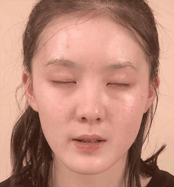 号称“1小时逆龄10年”的微整？我亲身体验了