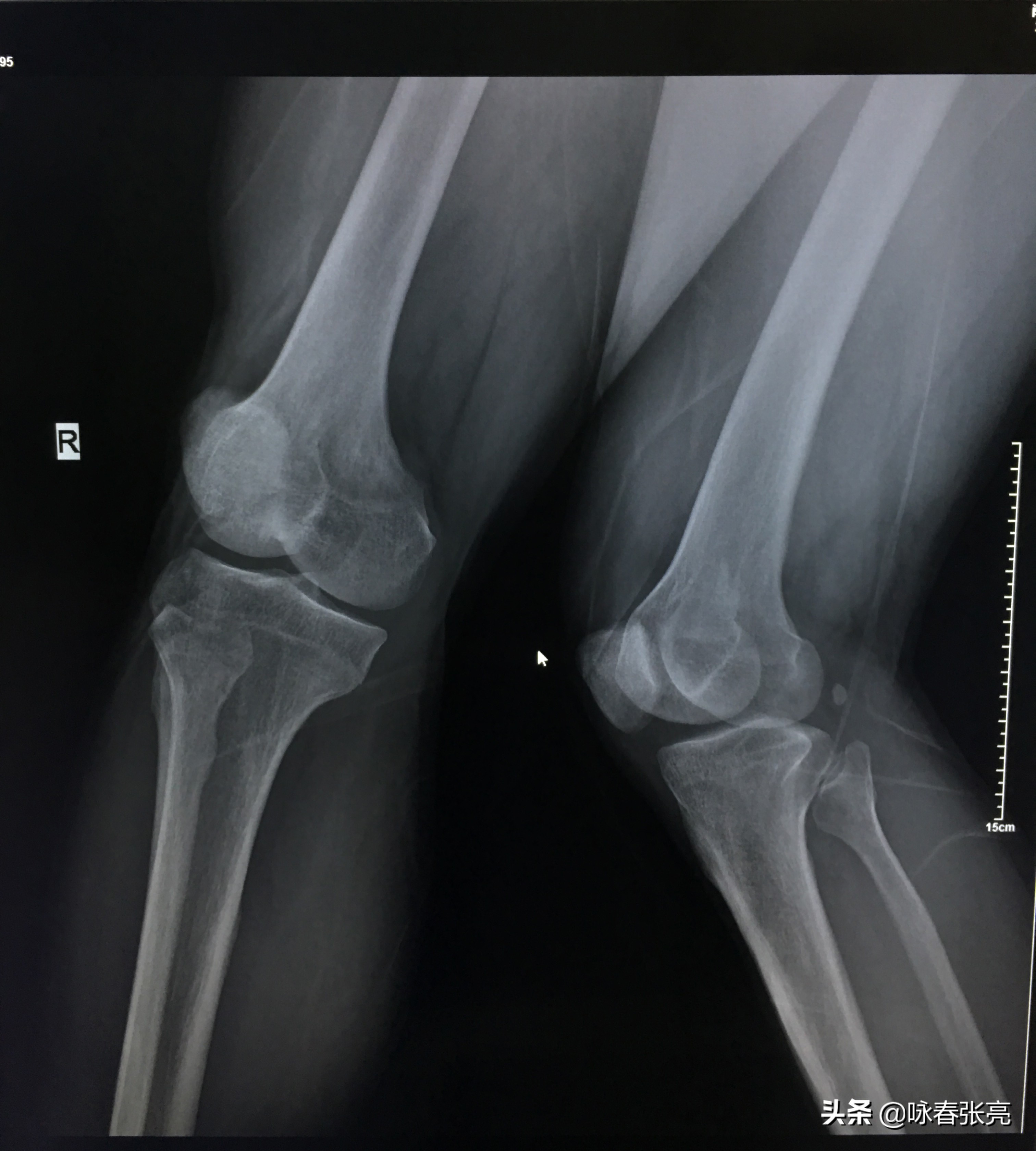 马步蹲怎样不伤膝,马步脚尖朝里还是朝外不伤膝