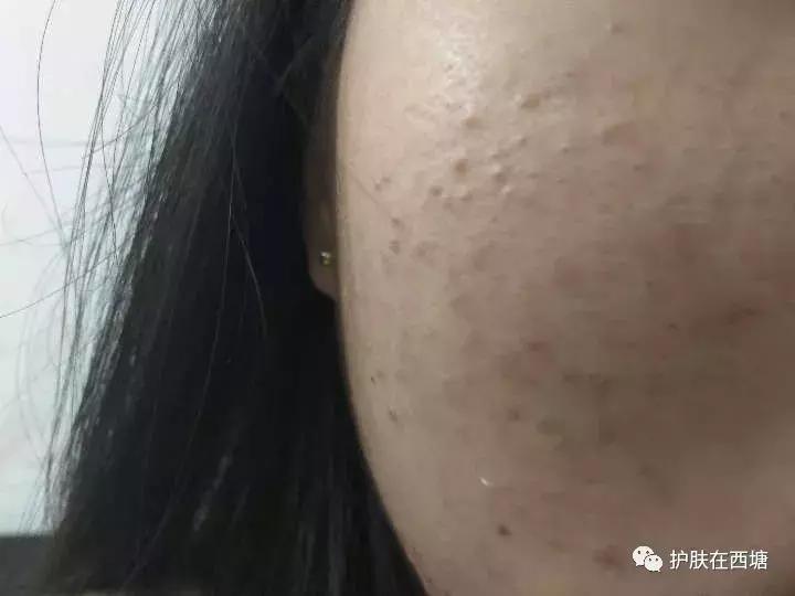 25岁痘痘还是反反复复不好,下巴痘痘反反复复是什么原因