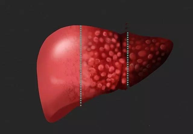 39岁男子查出肝癌,35岁男子查出肝癌身上有特殊记号