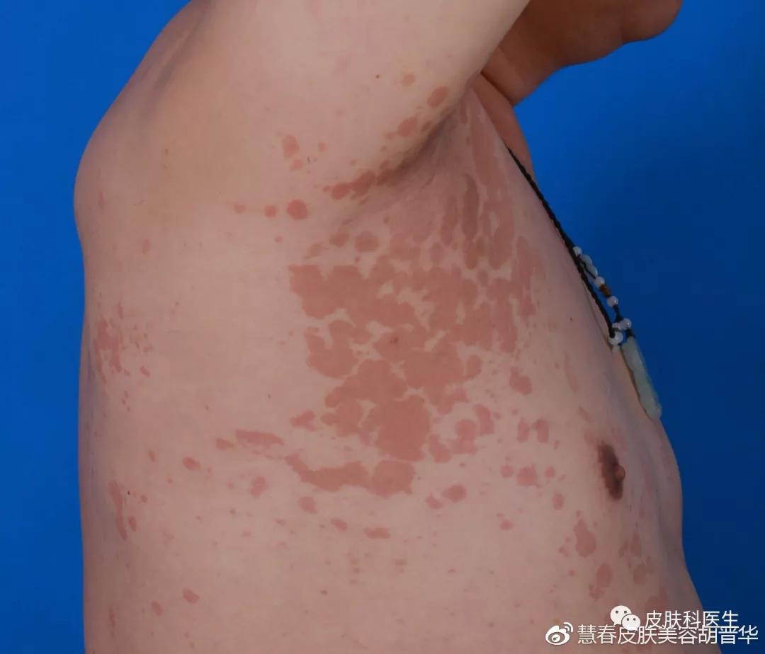 是湿疹或癣医生一眼就能辨出来吗,是不是体癣怎么检查