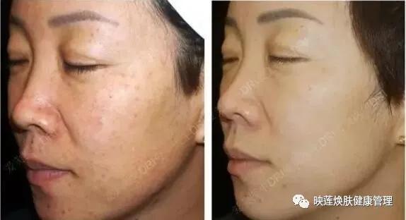 脸部皮肤严重缺水怎么调理,皮肤油光暗沉怎么办