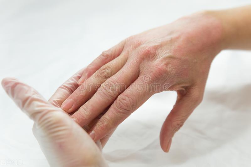 夏季湿疹反复的原因有两个,夏天湿疹与夏季皮炎的区别