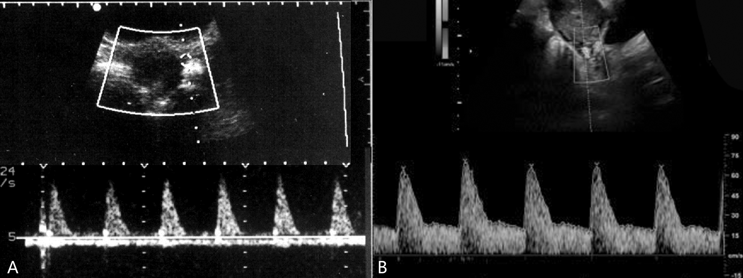 明明白白做超声23-2:妊娠期子宫及卵巢超声多普勒检查