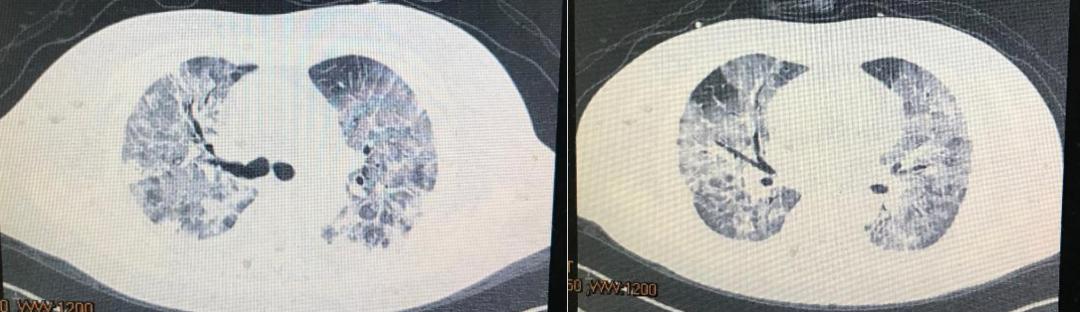 HFNC可能比无创通气更适合用于COVID-19导致的低氧血症？