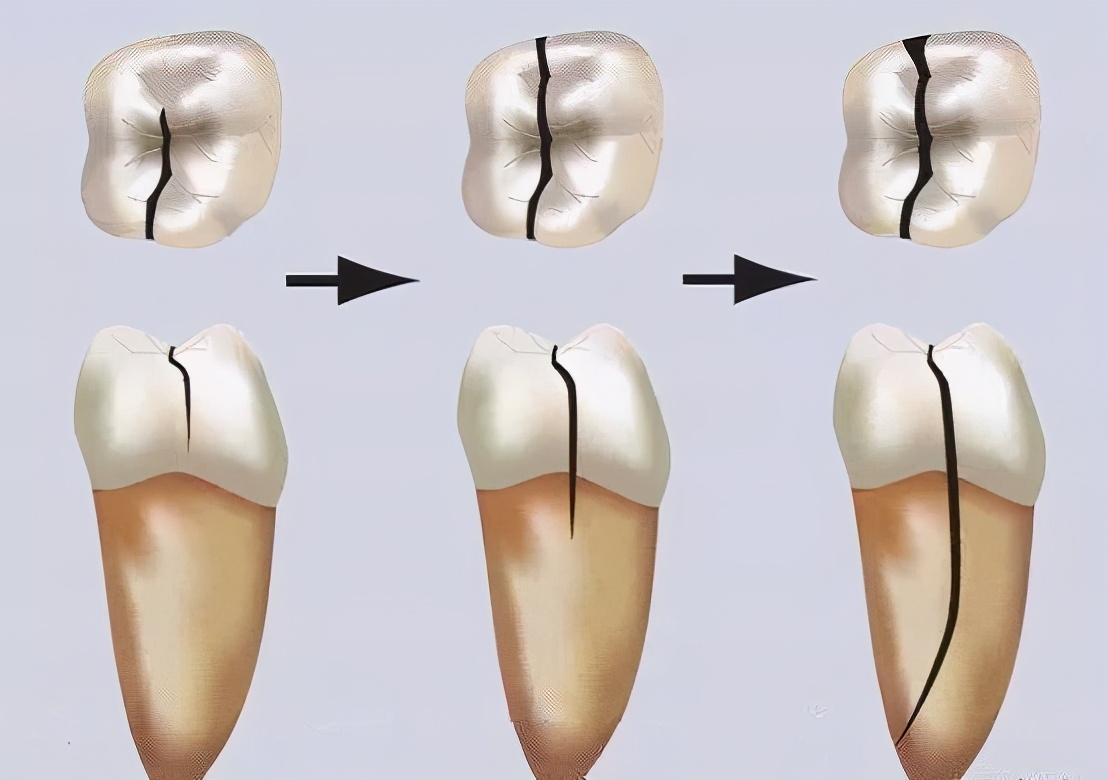 没蛀牙但是牙痛牙龈肿,没蛀牙只是牙髓炎怎么治疗