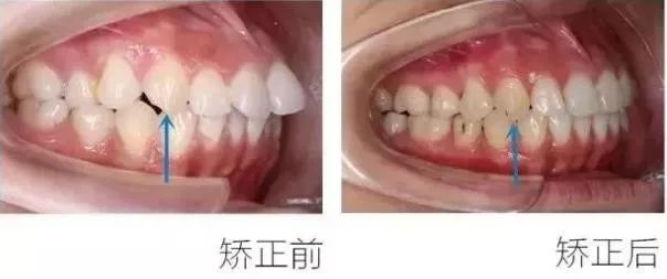 正畸主治学习视频,正畸钟摆效应名词解释