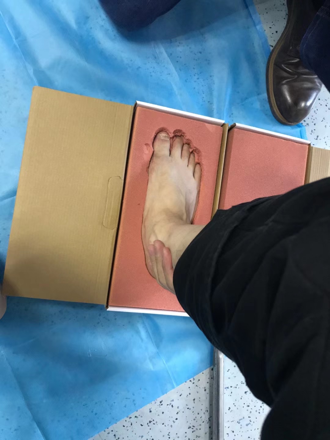 拇外翻微创手术的全过程,医生自己给自己做拇外翻手术