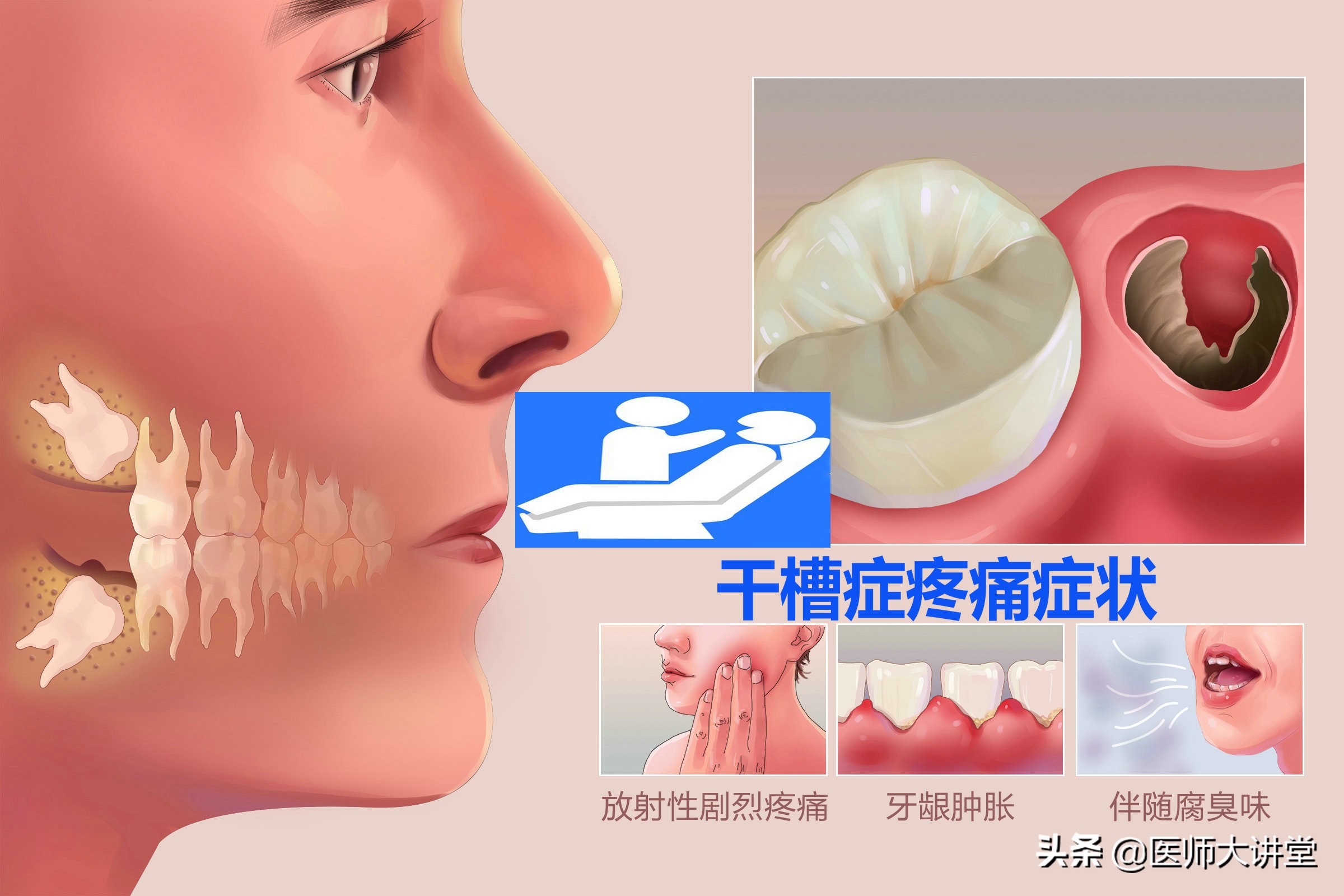 探讨56岁刘大姐拔除立事牙15天后疼痛肿胀的原因分析