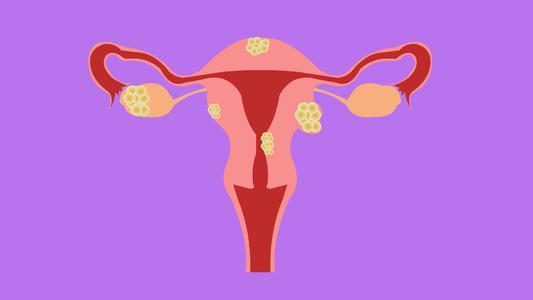 子宫肌瘤癌变怎么处理,子宫肌瘤癌变切除子宫能够根除吗