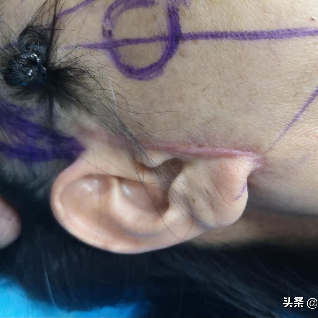 小切口拉皮和筋膜折叠哪种效果好,筋膜提升和剥离大拉皮的区别