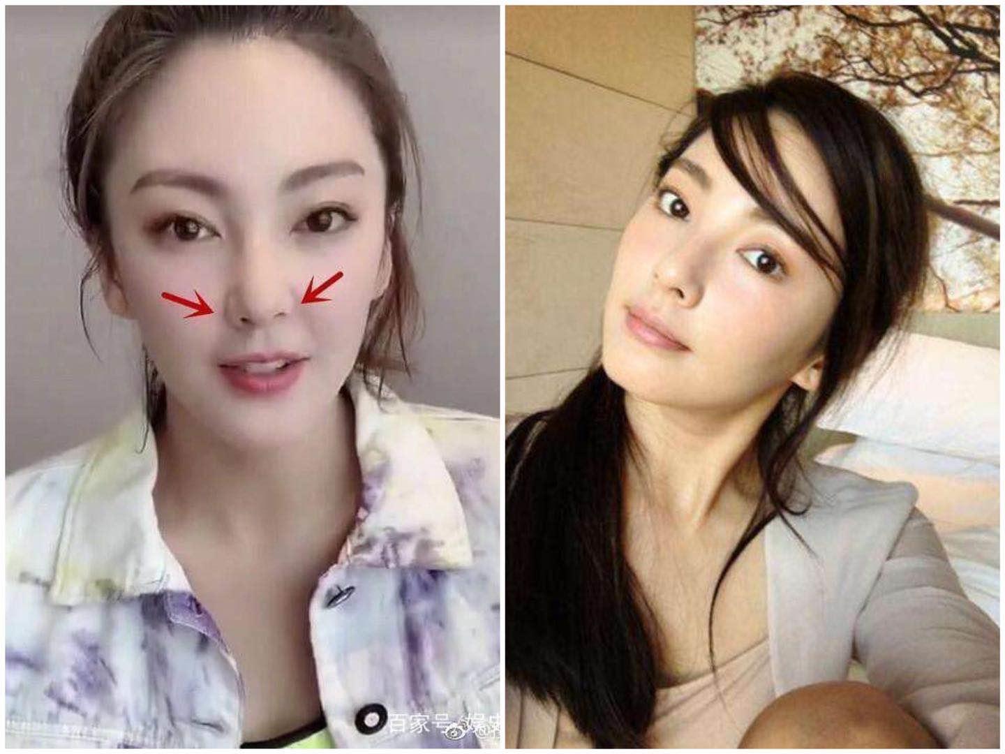 一些注射了玻尿酸的女人,那些做医美的女人最后怎么样了