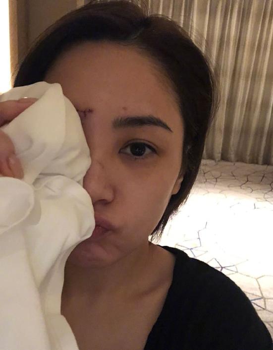 医美专家爆阿娇6㎝伤口肯定留疤痕，激光也难以恢复平滑肌肤