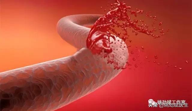 大便带血鲜红不痛应注意什么,大便带鲜血不疼痛